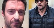 Hugh Jackman MIAŁ RAKA SKÓRY!