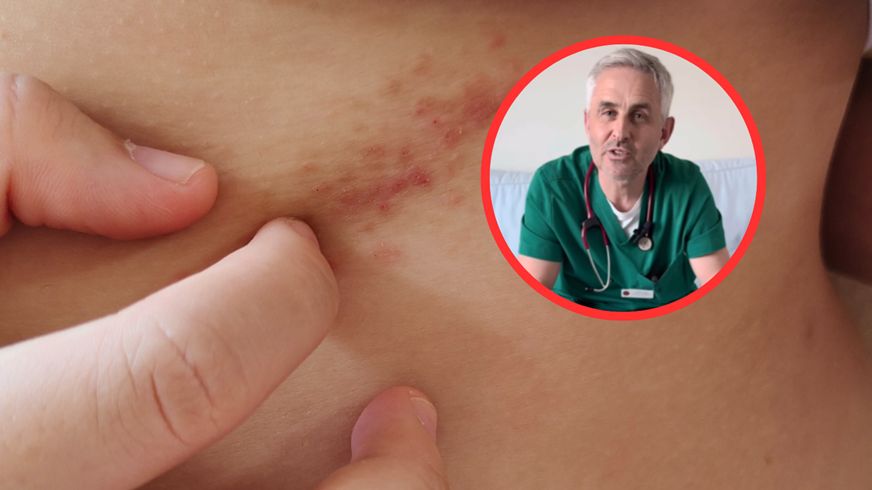 "Uszczypnięcie bociana" na skórze. Pediatra tłumaczy, czy jest się czym martwić