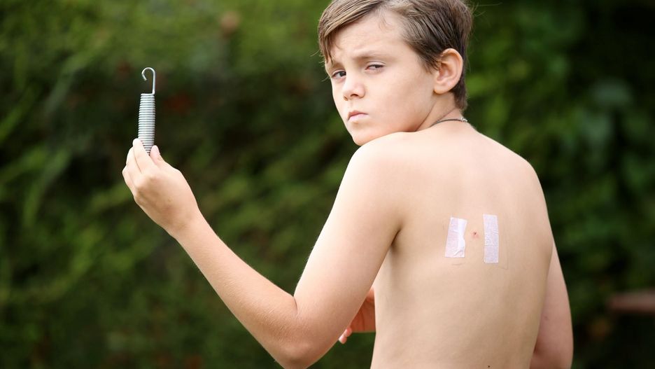 facebook / Podczas zabawy na trampolinie wbiła mu się sprężyna w plecy