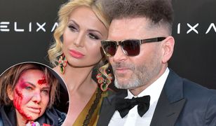 Żona Rutkowskiego cała we krwi. Zdjęcie wstrząsnęło internautami