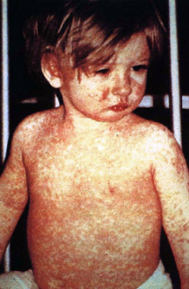Odra powraca do Europy – WHO ostrzega przed epidemią