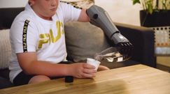 Technologiczna sensacja. 11-latek dostał bioniczne ramię