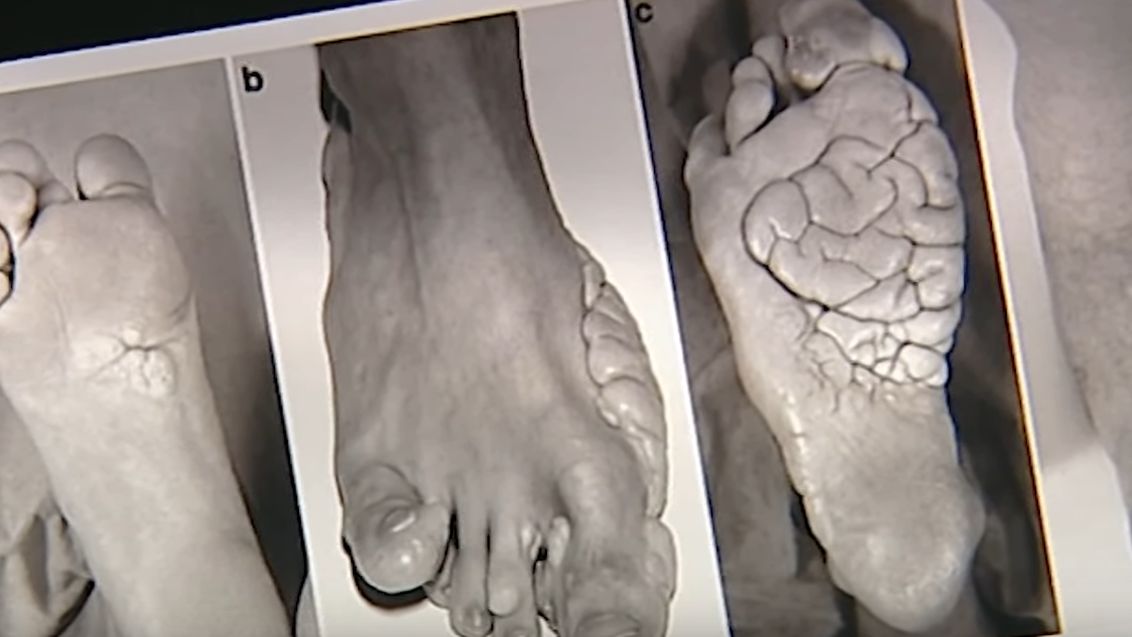 Zespół Proteusza to rzadka choroba genetyczna, za która odpowiada mutację genu AKT1. Jej głównym objawem jest asymetryczny i nieproporcjonalny przerost części ciała oraz skłonność do tworzenia guzów. 