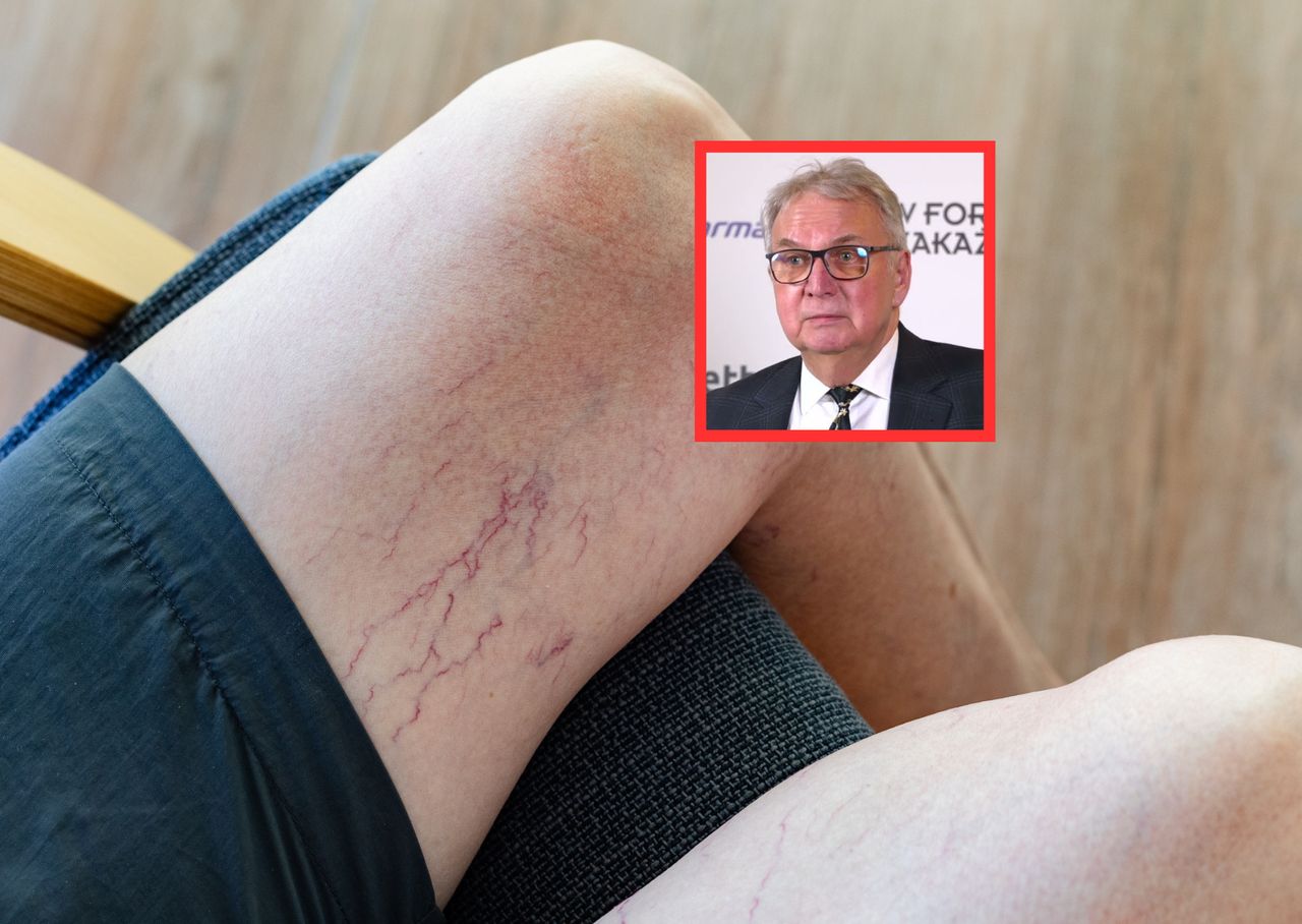 Sprawca zakrzepów i miażdżycy. "Tzw. serce żylne przestaje pracować"