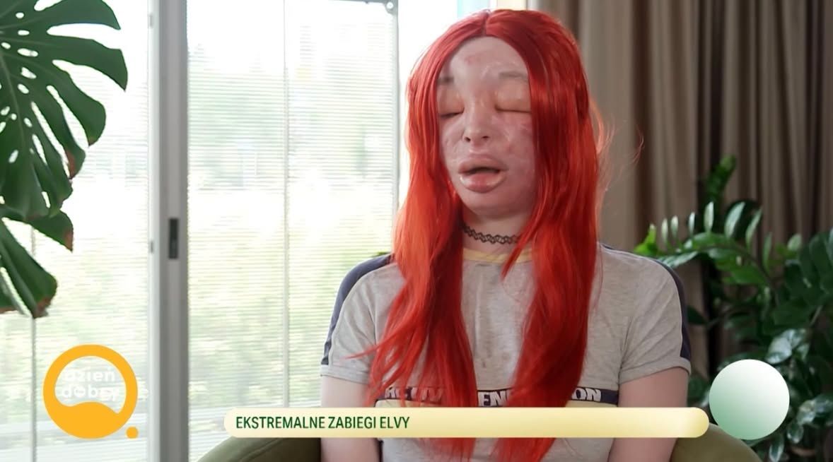 26-letnia Elva zdeformowała sobie twarz