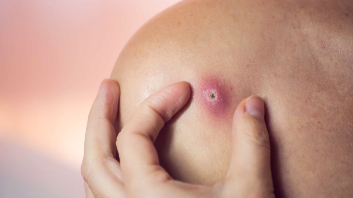 Czyrak to zmiana, która ma postać guzka