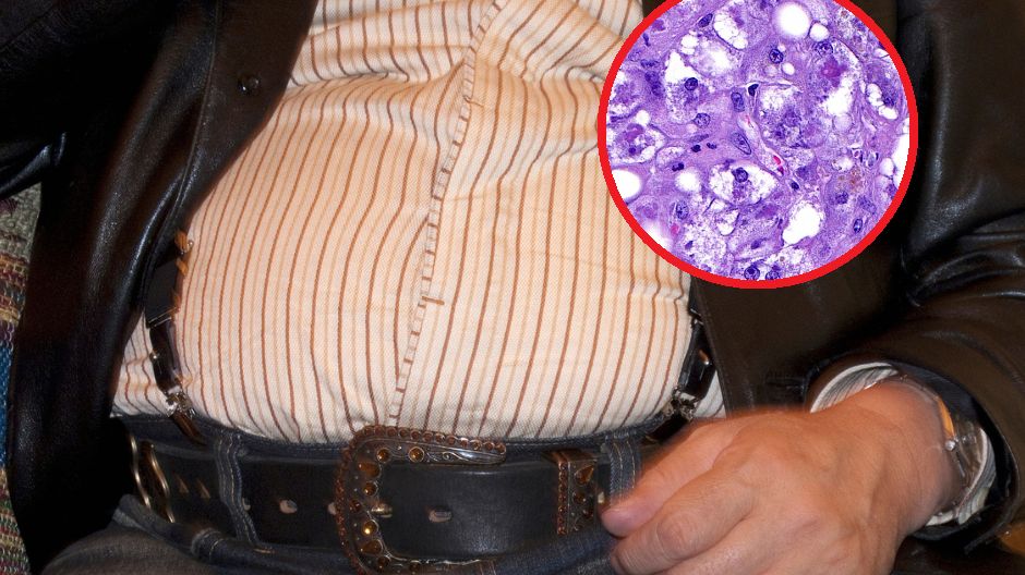 Restrykcyjne diety i szybka utrata masy ciała mogą sprzyjać stłuszczeniu wątroby