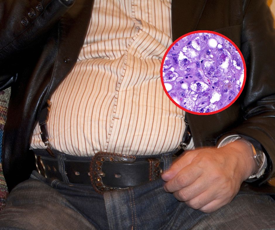 Mają sylwetkę kasztanowego ludzika. To znak, że wątroba jest w ruinie