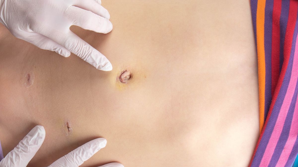 Doctor´s hands examining incisions after a laparoscopic surgery
Doctor´s hands in medical gloves examining a patient´s abdomen and wounds / cuts that are healing after a laparoscopic surgery. Post surgery follow-up visit and examination
Eik Scott