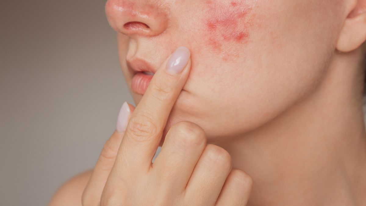 Demodex folliculorum i Demodex brevis to gatunki pasożyta, który bytuje w skórze człowieka.