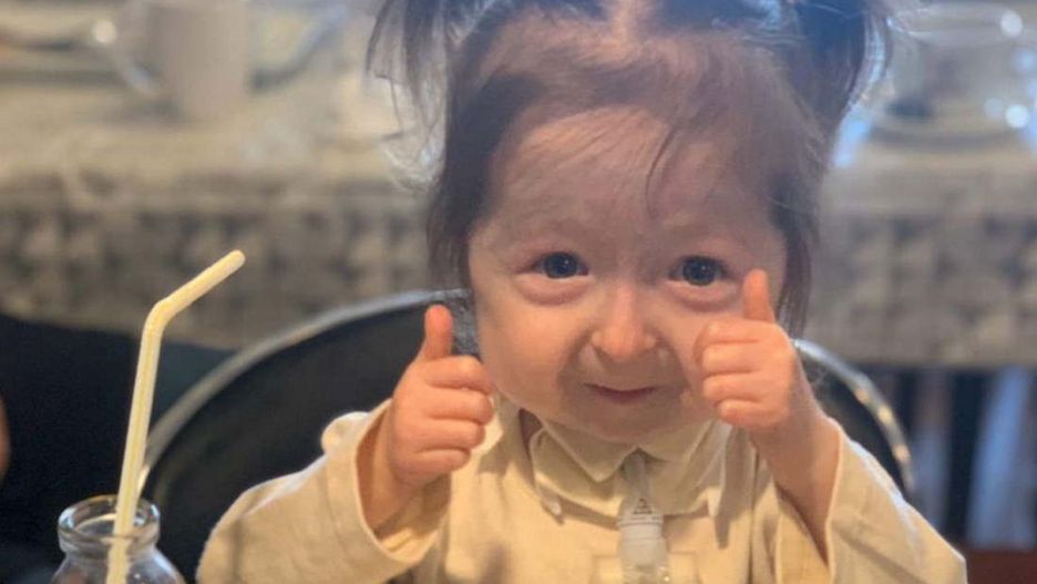 Jako dziecko wyglądała jak staruszka. Jest jedyną osobą na świecie z tym schorzeniem