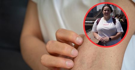 Patrycja diagnozę otrzymała w wieku 25 lat. Taki był pierwszy znak raka trzustki