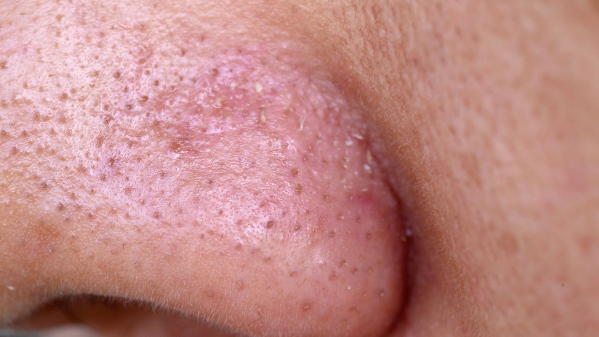 Jak usunąć wągry?