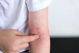 Atopowe zapalenie skóry (AZS) – objawy, przyczyny, leczenie i profilaktyka