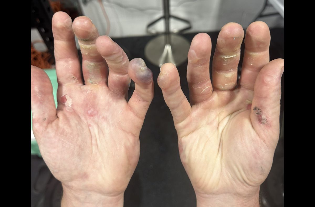 Doug "Censor" Marti showed his mangled hands