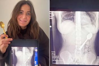 Połknęła 17-centymetrową łyżeczkę. "Czułam, jak się przemieszcza"