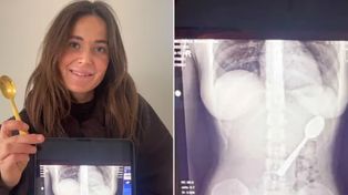 Połknęła 17-centymetrową łyżeczkę. "Czułam, jak się przemieszcza"