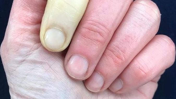 Jenni cierpi na objaw Raynauda