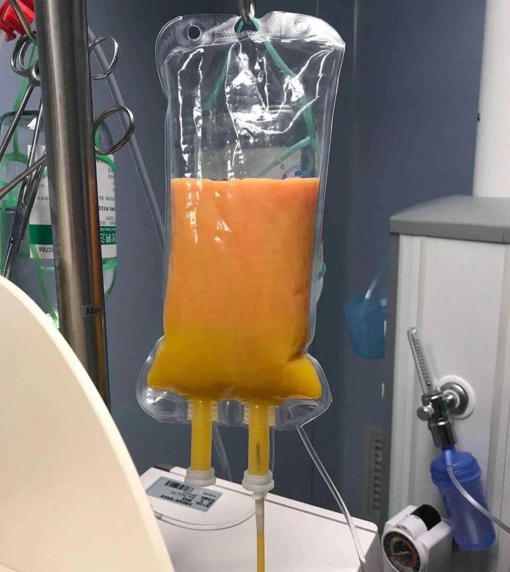 Tłuszcz z przefiltrowanej krwi kobiety