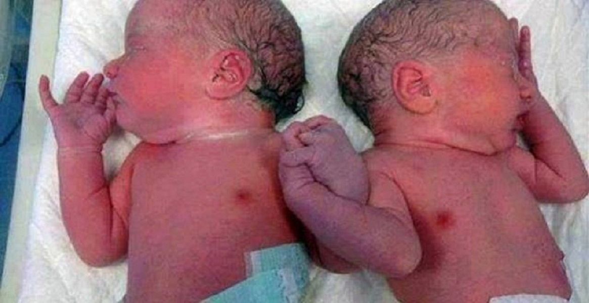 Bliźniaczki w chwili narodzin trzymały się za ręce
