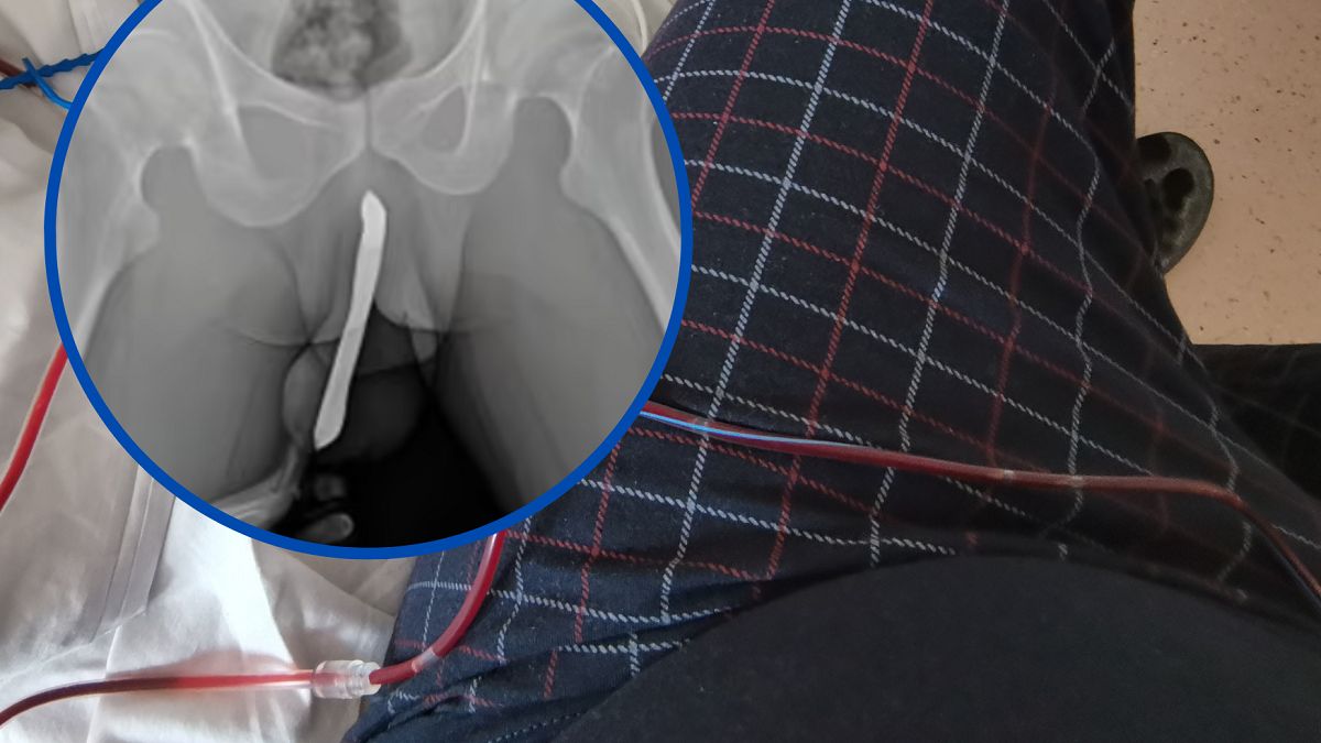 Szok. Mężczyzna złamał prącie. 