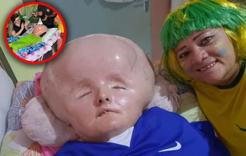 Ma wodogłowie, lekarze dawali jej 3 miesiące. Niedawno skończyła 33 lata