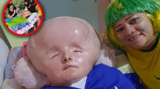 Ma wodogłowie, lekarze dawali jej 3 miesiące. Niedawno skończyła 33 lata