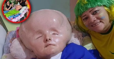 Ma wodogłowie, lekarze dawali jej 3 miesiące. Niedawno skończyła 33 lata