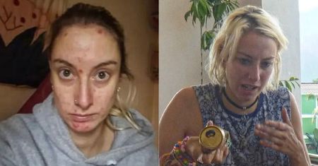 Piła dwie butelki wódki dziennie. Dziś 35-latka jest nie do poznania. Pokazała, co alkohol zrobił z jej cerą (ZDJĘCIA)