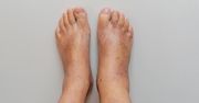 Mało znany objaw raka. Zwróć uwagę na palce u stóp