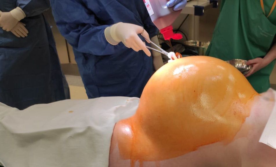 Pacjentka z Krosna miała 30-kilogramowy guz jajnika