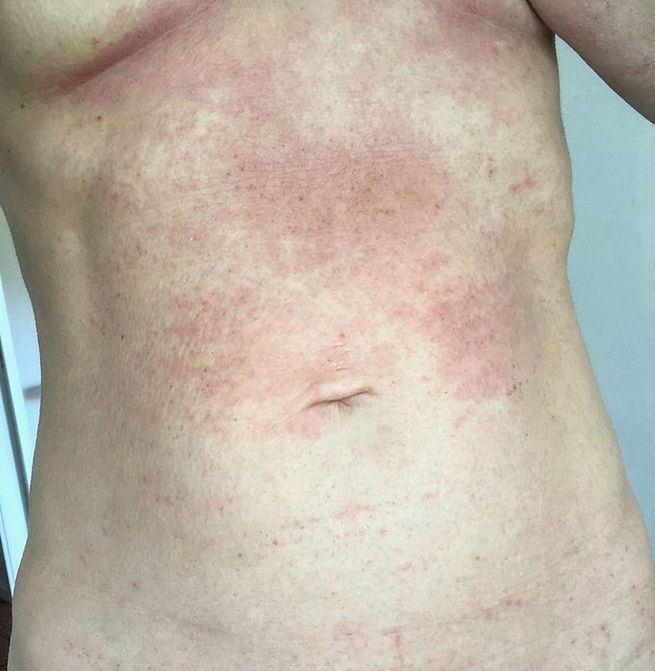 Wysypka na brzuchu Claire