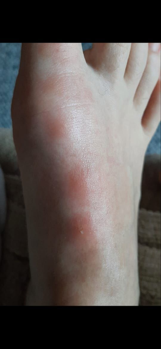 Wysypka utrzymuje się już od kilku miesięcy