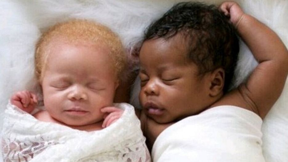 Ich zdjęcia obiegły świat. Tak słynne bliźnięta wyglądają dzisiaj