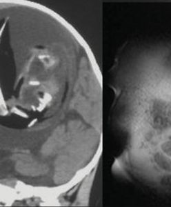 Nienarodzony bliźniak był w mózgu siostry. Został usunięty