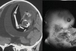 Nienarodzony bliźniak był w mózgu siostry. Został usunięty