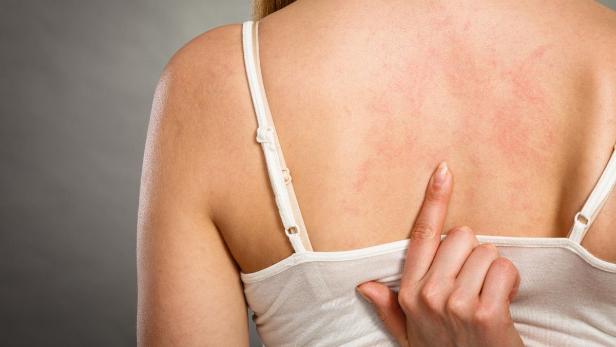 Pokrzywka idiopatyczna to swędzące zmiany skórne, które często pojawiają się z niewiadomego powodu.