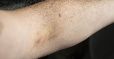 Cukrzyca typu 2. Pierwsze objawy widać na skórze