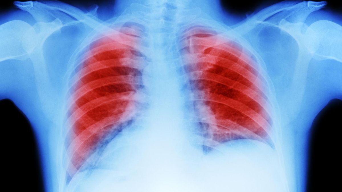 Dlaczego rak płuc rozwija się u niepalących?