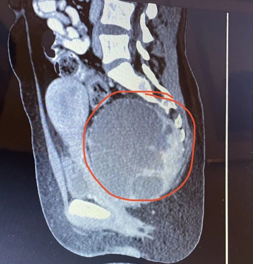 Badania wykazały, że guz miał 14 cm i rósł tak szybko, że 25-latka potrzebowała cewnika