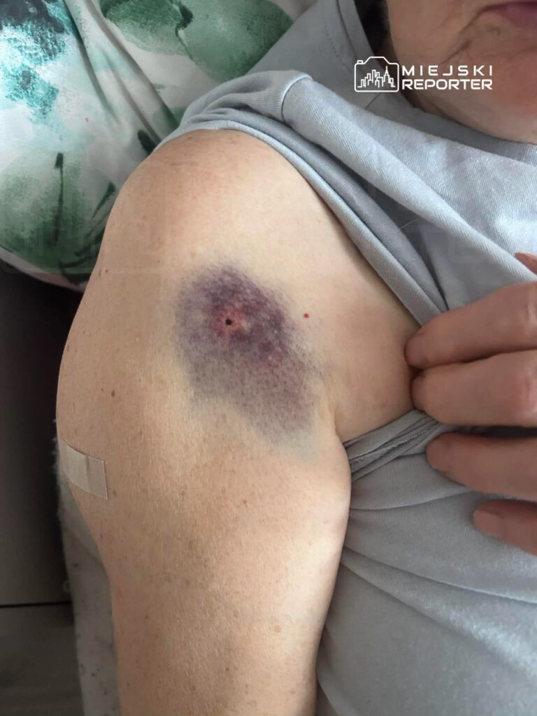 Na ramieniu osoby widoczny jest siniak o ciemnofioletowym zabarwieniu, obok plaster na skórze.