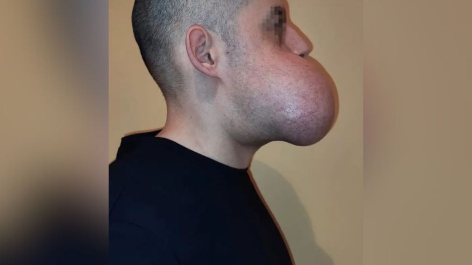 Guz zdeformował mu twarz. Do rekonstrukcji użyli