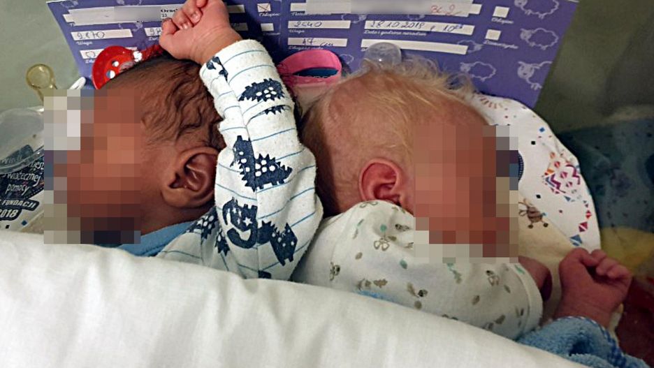 Bliźniaki o różnym kolorze skóry