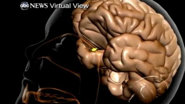 Na kąpieliskach grasuje pasożyt pożerający mózg 1