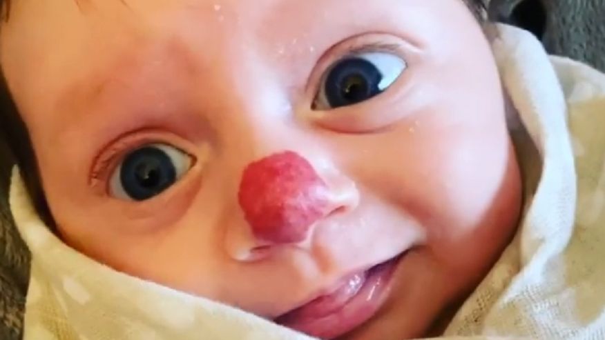 Urodziła się z nietypowym znamieniem. Półtoraroczna dziewczynka ma nos klauna