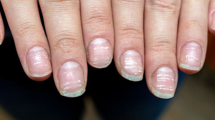 Chore serce i wątrobę zauważysz na paznokciach. Takich plamek nie lekceważ