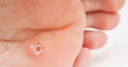 Brodawki, kurzajki i wirus HPV – co powinieneś wiedzieć?