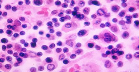 Nowa epidemia w USA. Ponad 600 zakażonych. A zaczęło się od... cebuli