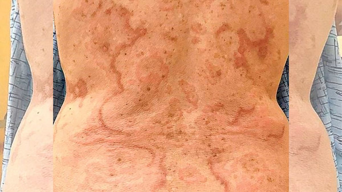 Nietypowa wysypka okazała się objawem raka odbytu