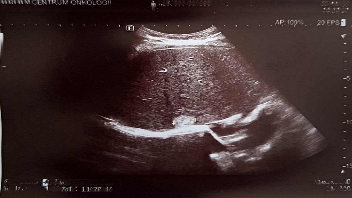 Naczyniak wątroby w większości przypadków jest niegroźną zmianą.